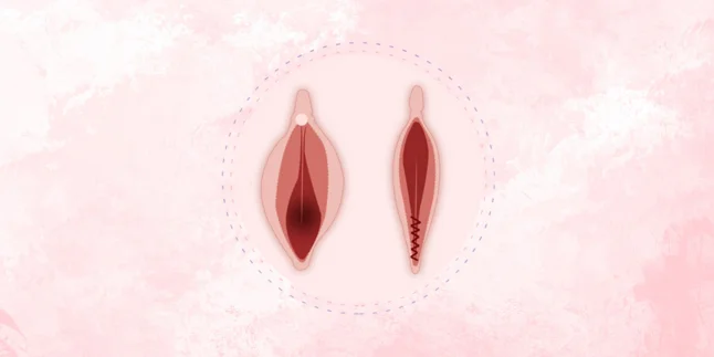 Perineoplasty Surgery by Dr. Amulya Gumpalli in Madhapur, Hyderabad – Expert Cosmetic Gynecology Care